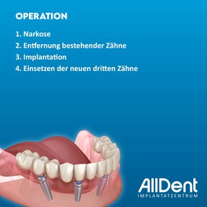Feste dritte Zähne Infografik